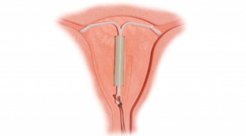 IUD, pajisje hormonale intrauterine
