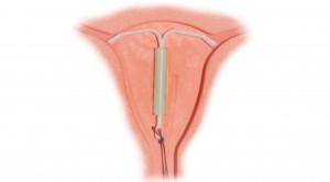 IUD, pajisje hormonale intrauterine